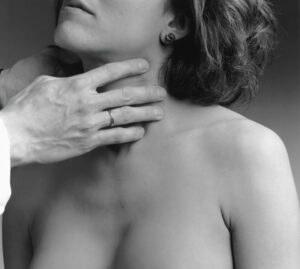 Hashimoto Thyeroiditis